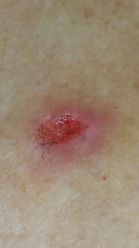 Morgellons disease photo : Lesion of breast
