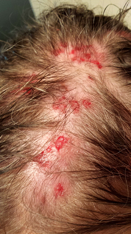 Morgellons disease photo : Scalp lesions with hair loss