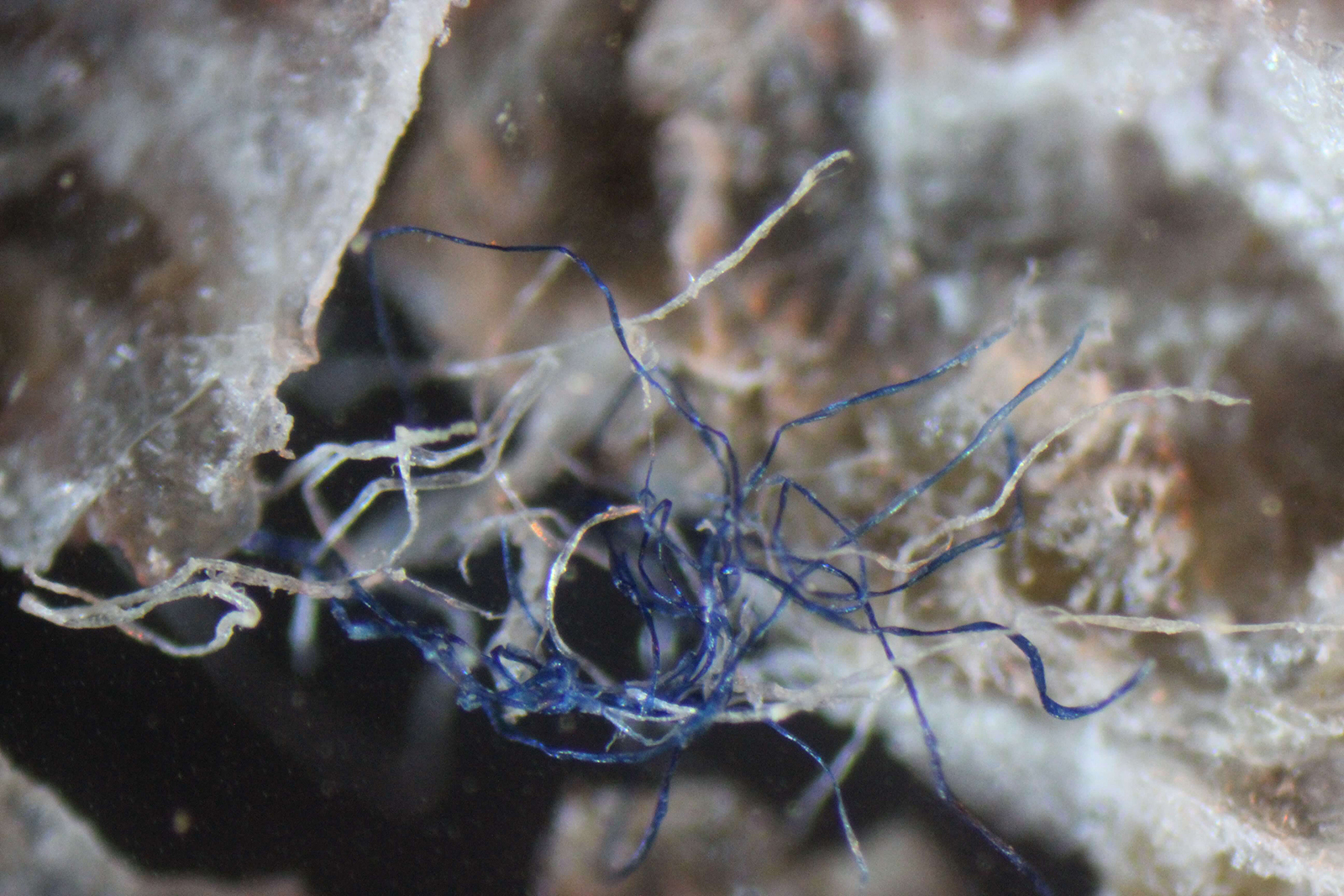 Morgellons disease photo : Blue and white filaments intertwined in a scab