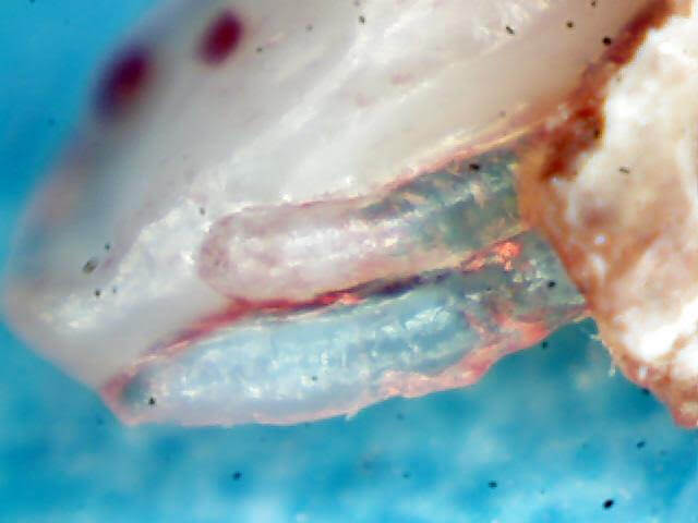 Morgellons disease photo : Gel plug with blue fibers inside