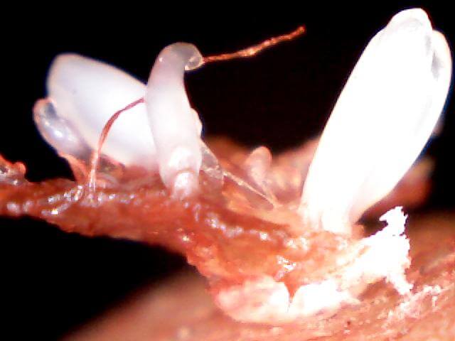 Morgellons disease photo : Scab with keratin projections underneath