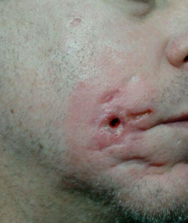 Morgellons disease photo : Hole starting in face