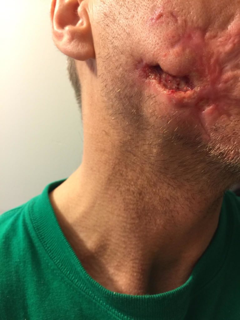Morgellons disease photo : Cheek lesion expanded