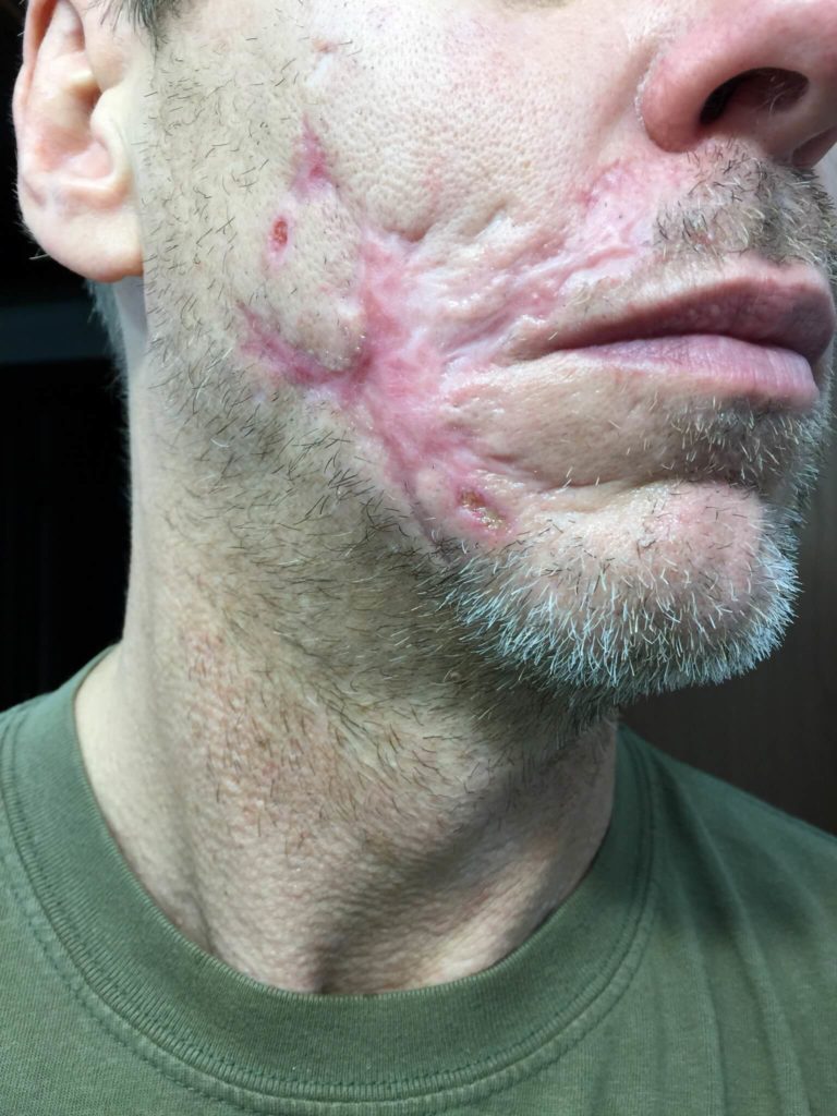 Morgellons disease photo : Macerated side of face