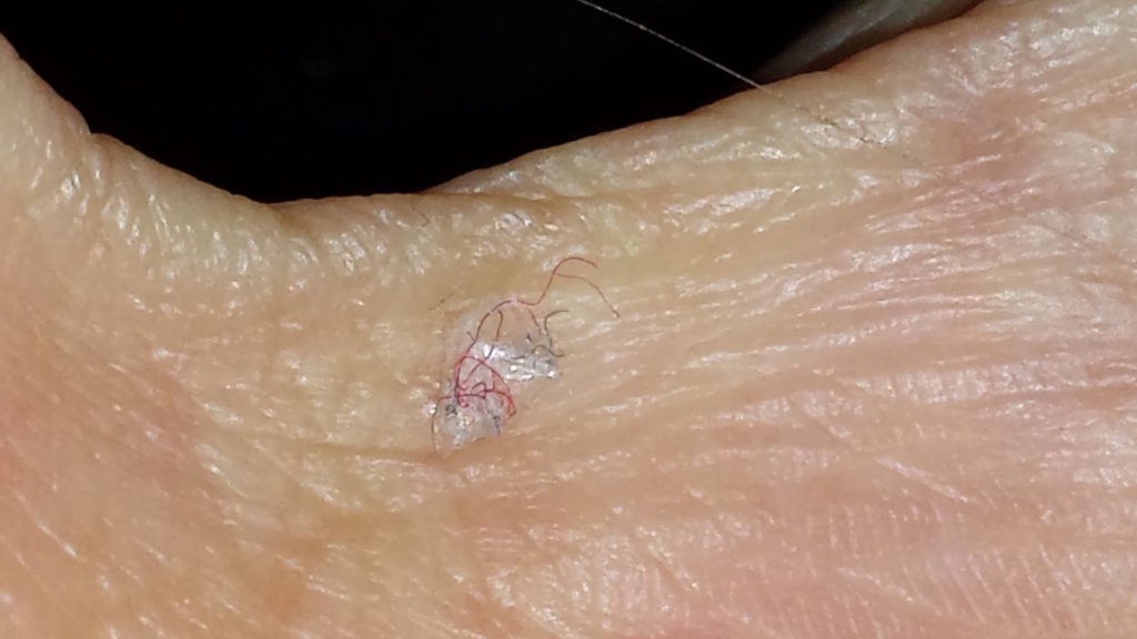 Morgellons disease photo : Filaments in base of thumb