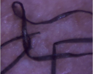 Morgellons disease photo : Flat ribbon like fiber from a vagina
