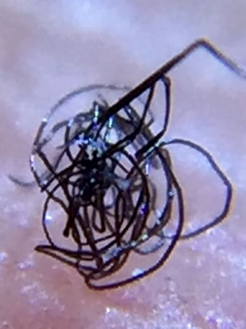 Morgellons disease photo : Mass of black fibers also known as fuzz balls at 60X magnification