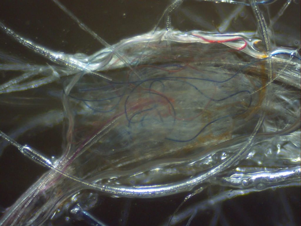 Morgellons disease photo : Red, blue, and white filaments in gelatinous exudates