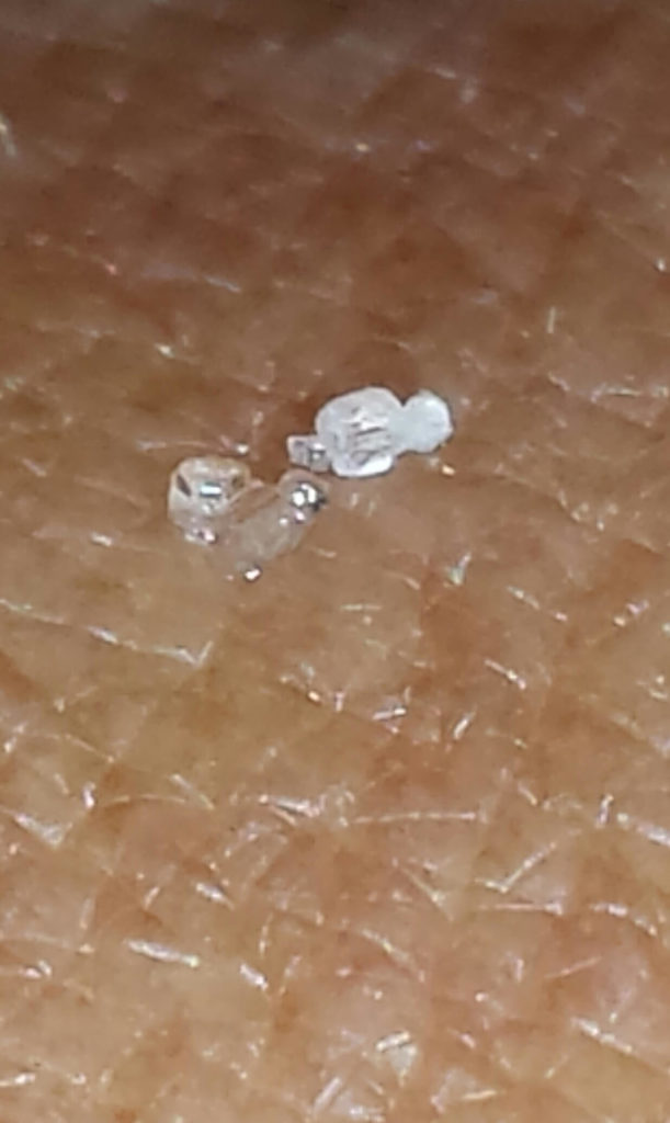 Morgellons disease photo : Crystal-like exudates from skin pores