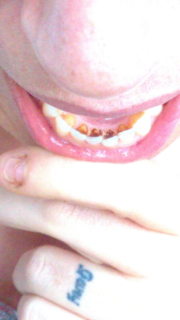 Morgellons disease photo : Blackening of teeth close to the gum line