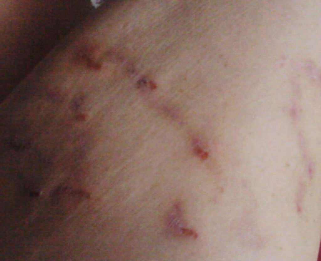 Morgellons disease photo : Streaks across a patient's skin consistent with Bartonella striae