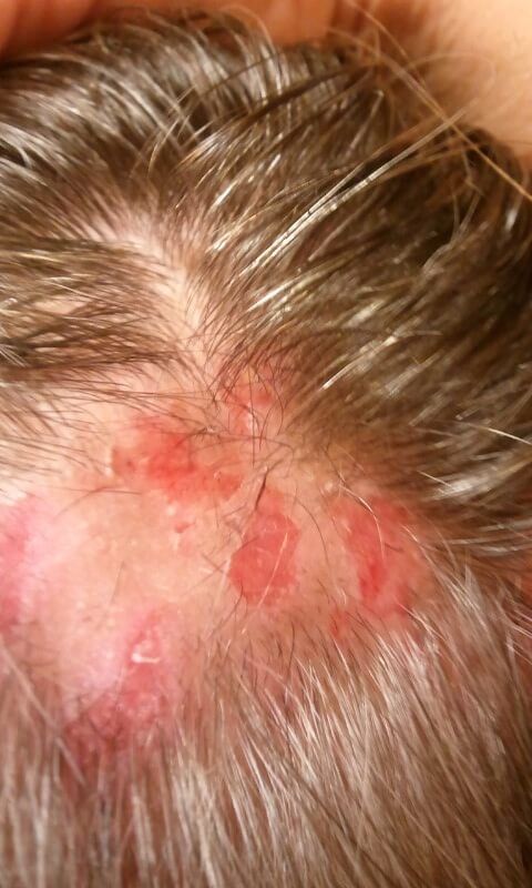 Morgellons disease photo : Mound with lesions, showing hair loss