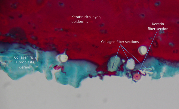 Morgellons disease photo : Gomori Trichrome stain, keratin = red, collage = blue/green