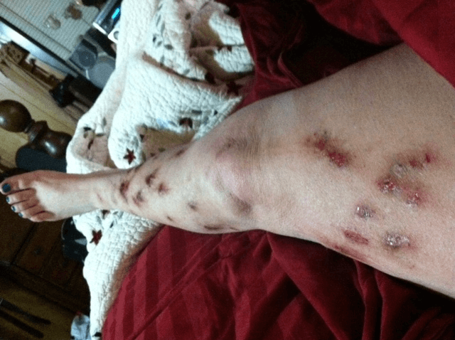 Morgellons disease photo : Cindy's leg before morgellons disease treatment